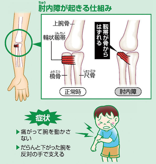 肘内障