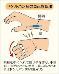 ド・ケルバン病
